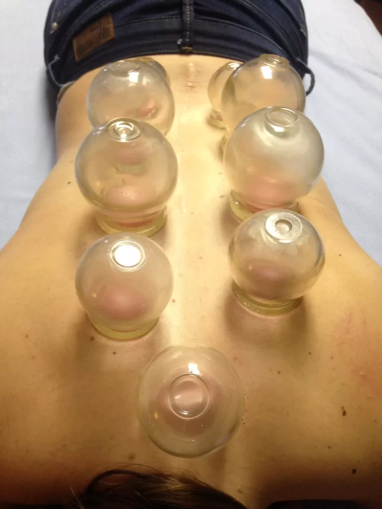 fire cupping