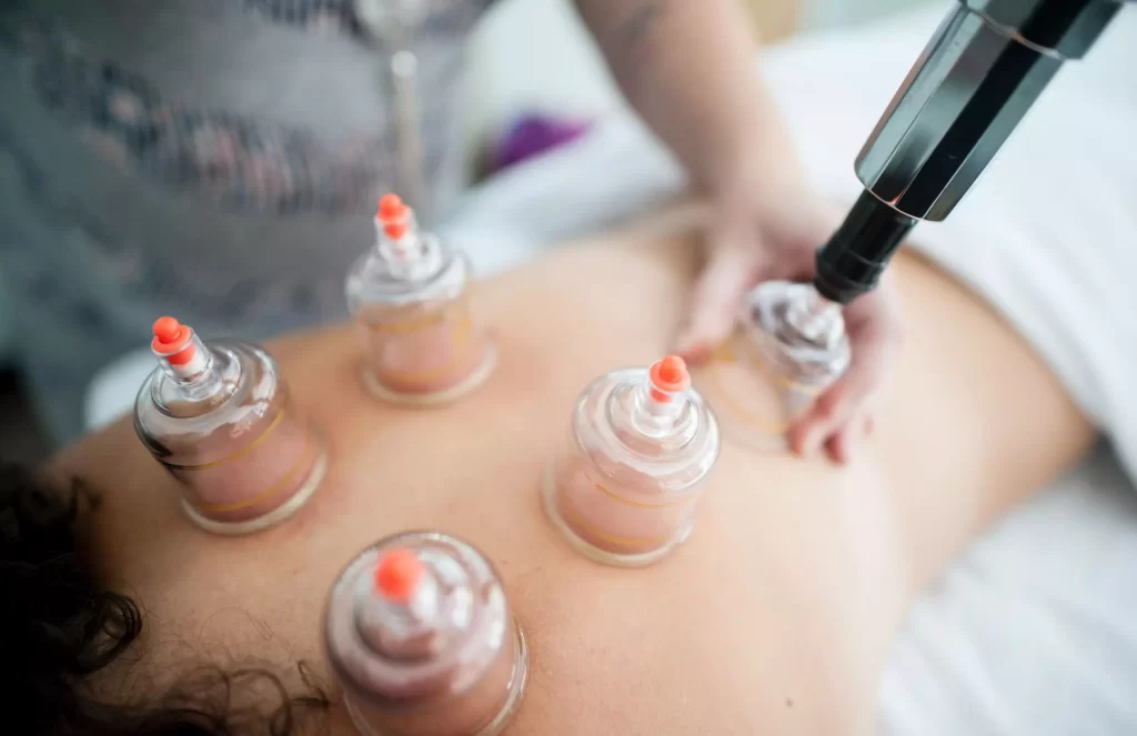 top cupping therapy in new orleans