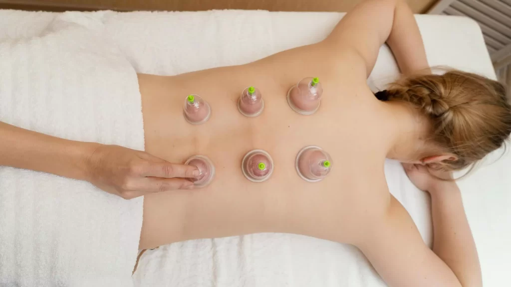 wet cupping