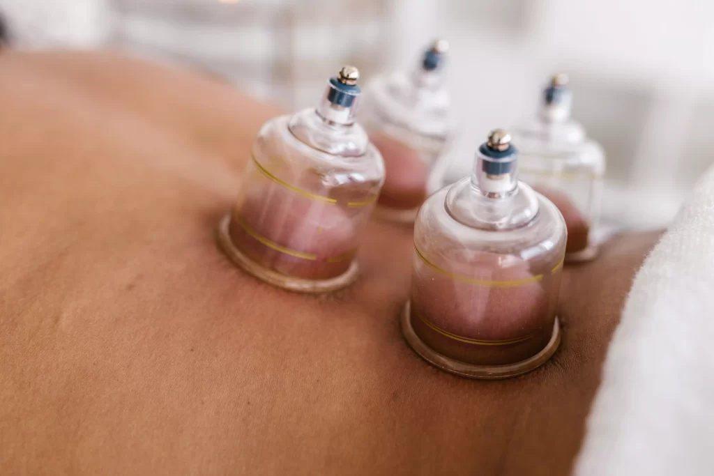 cupping therapy knowledge